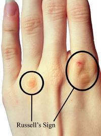 催吐减肥的三大危害,减肥吃多了催吐的危害