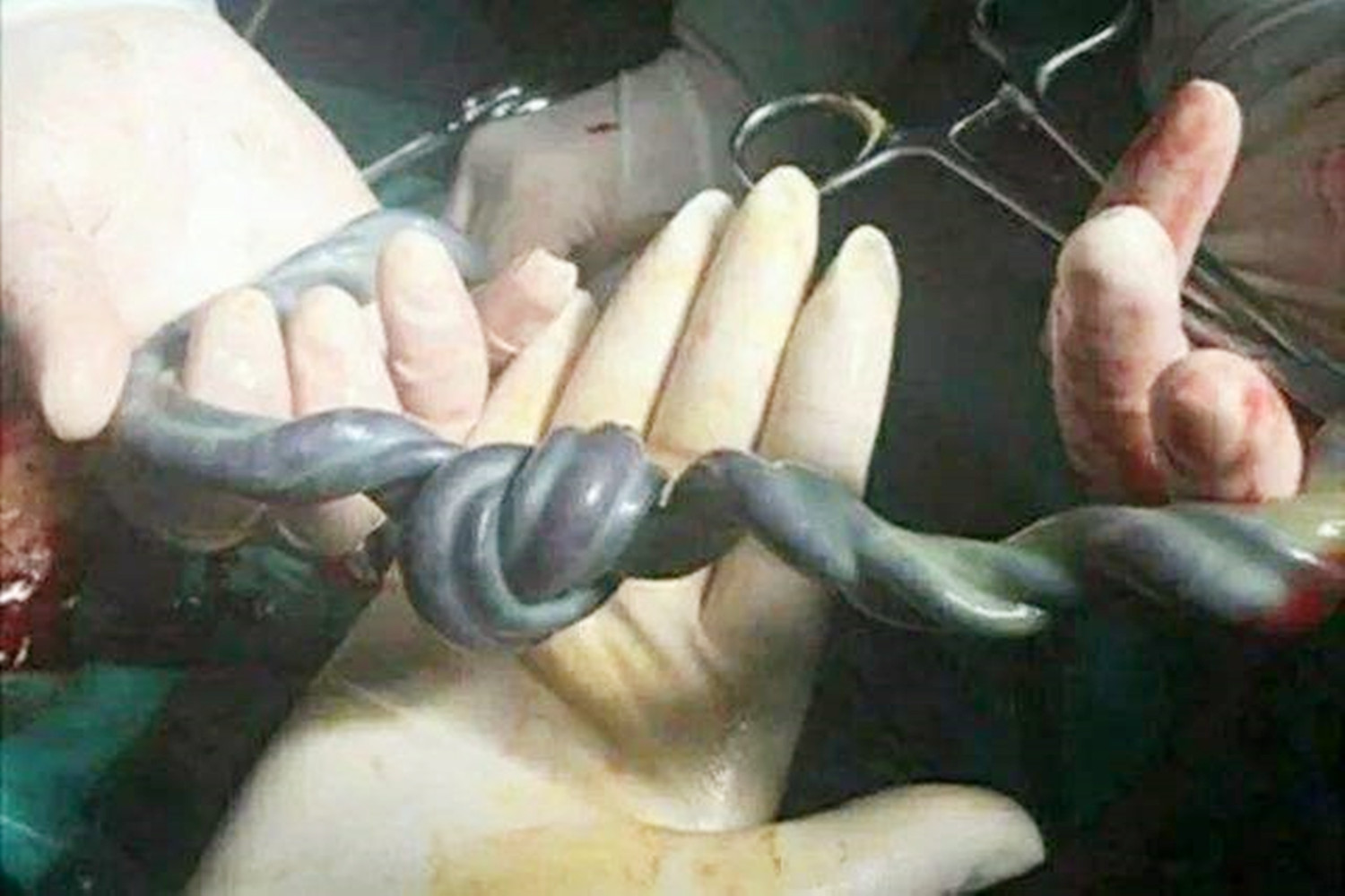 胎儿脐带在母体内断了是为什么,一般是什么原因引起脐带断裂