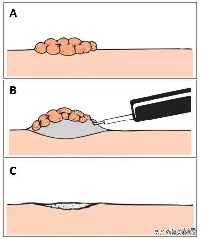 切肠息肉有风险吗,肠息肉为什么大了不能直接切