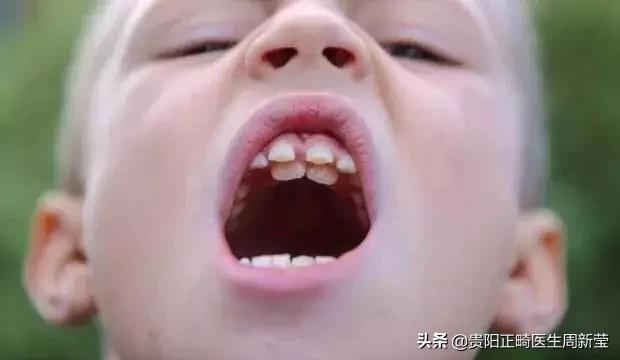 长了多生牙但是把恒牙给拔了,长了多生牙拔除疼吗