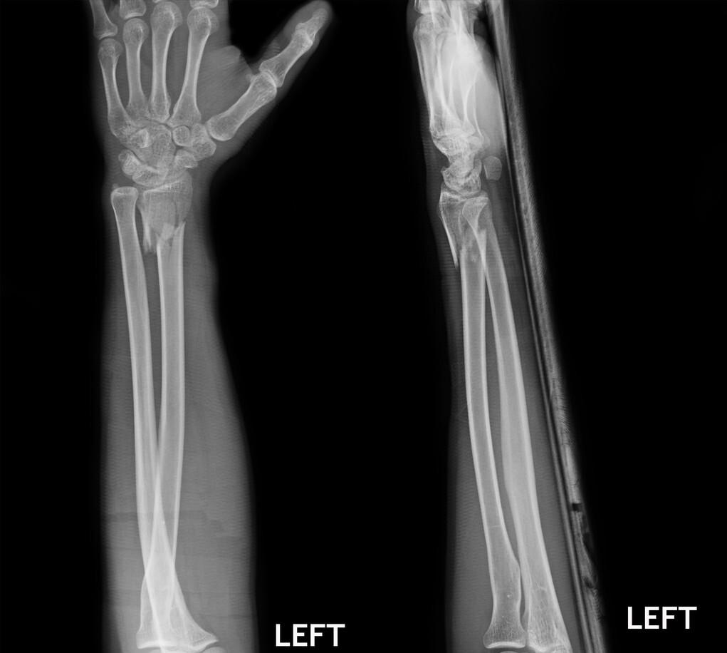 骨折固定的注意事项,骨折后需要注意哪里