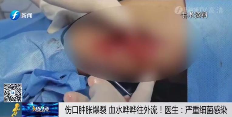 一个人在家里被大狗咬了,宠物猫咬主人一口主人被截肢