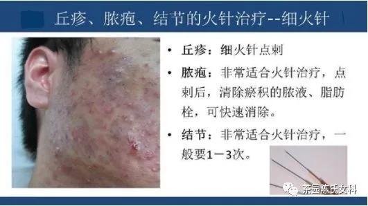 火针的应用范围,中医火针应用