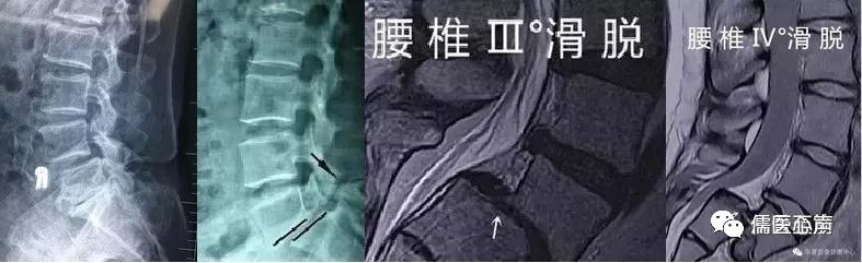 腰痛捉妖记（二十三）------没有受伤，我的腰椎怎么就滑脱了？
