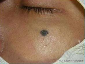 激光祛比较大的痣会癌变吗,为什么激光祛痣还会长出来