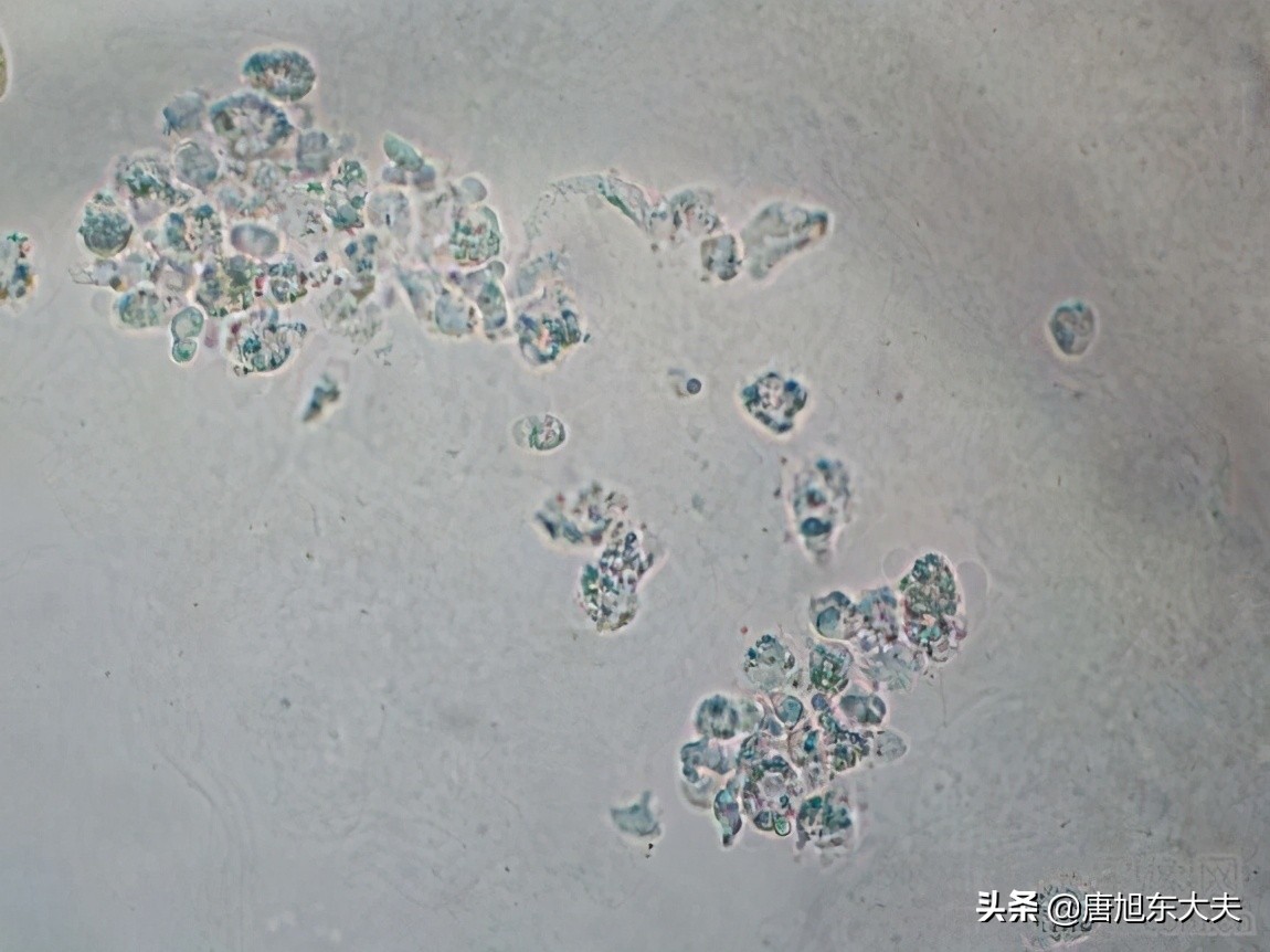 再生障碍贫血能把血液稳定住吗,再生障碍性贫血一直输血能活多久