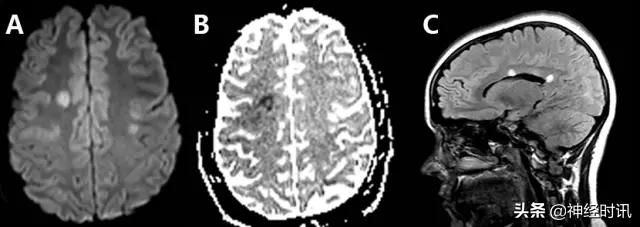 脑卒中病历诊断书图片,脑卒中影像判断技巧图解电子版