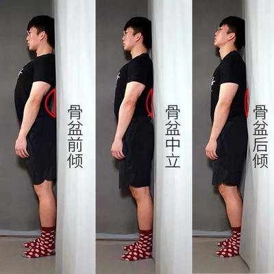 骨盆前倾了怎么办？中医陈莹推荐您三个方法