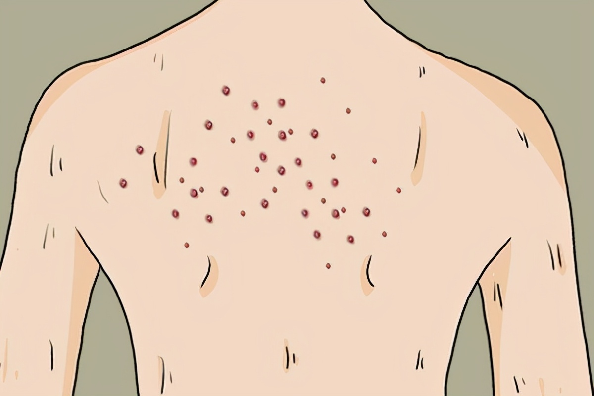 容易长痘和毛囊炎是什么原因,身体上怎么分辨是痘痘还是毛囊炎