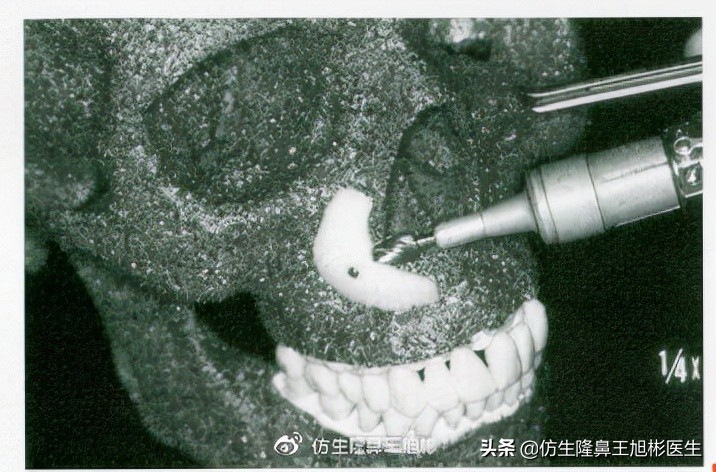 鼻基底填充会移位到鼻孔吗,鼻基底填充假体会拉长人中吗