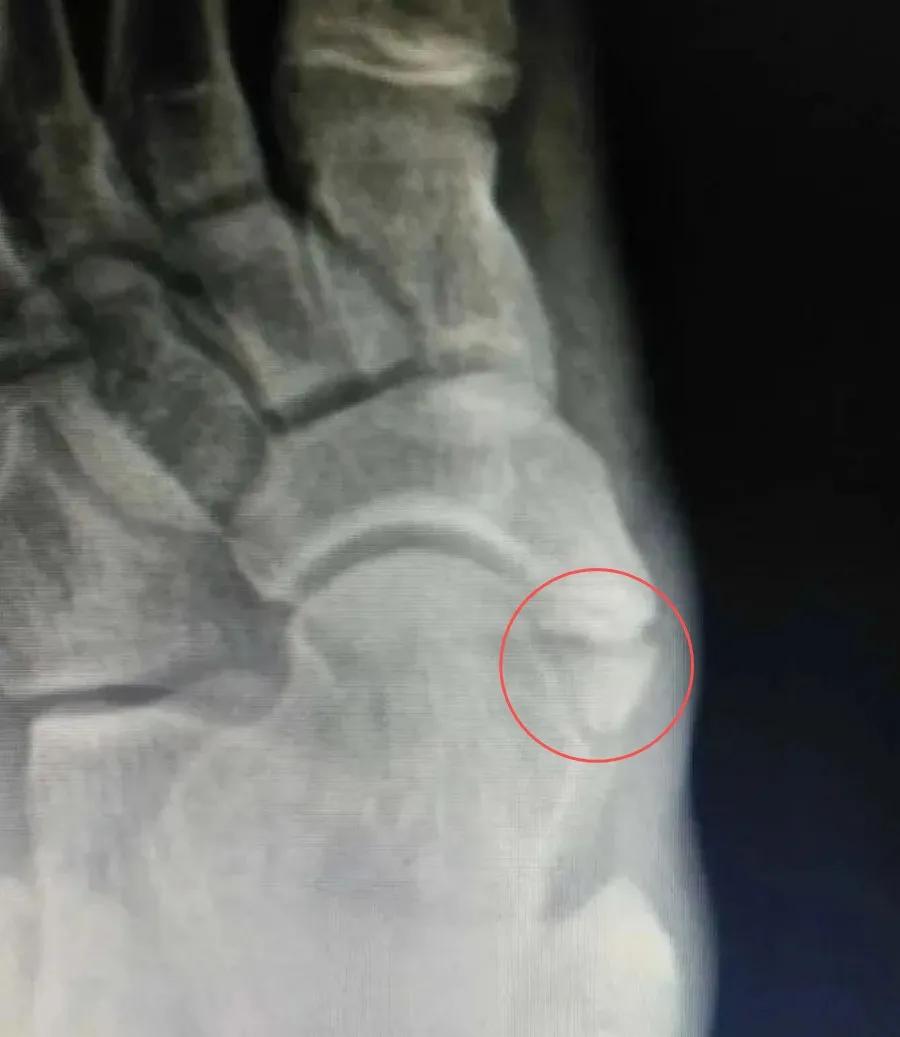 脚上多长了块骨头,腿关节多长了一块骨头