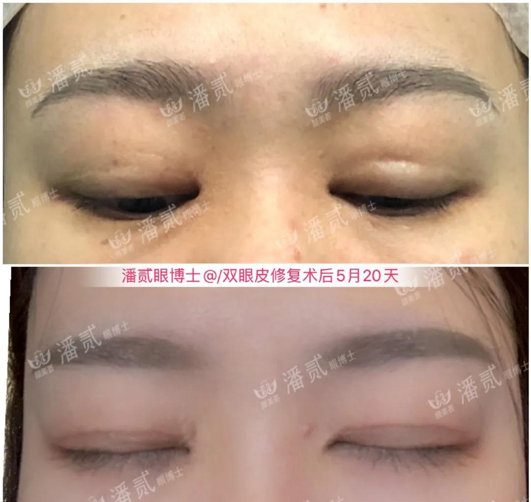 双眼皮修复改扇形双眼皮,平行双眼皮能改成开扇形双眼皮吗