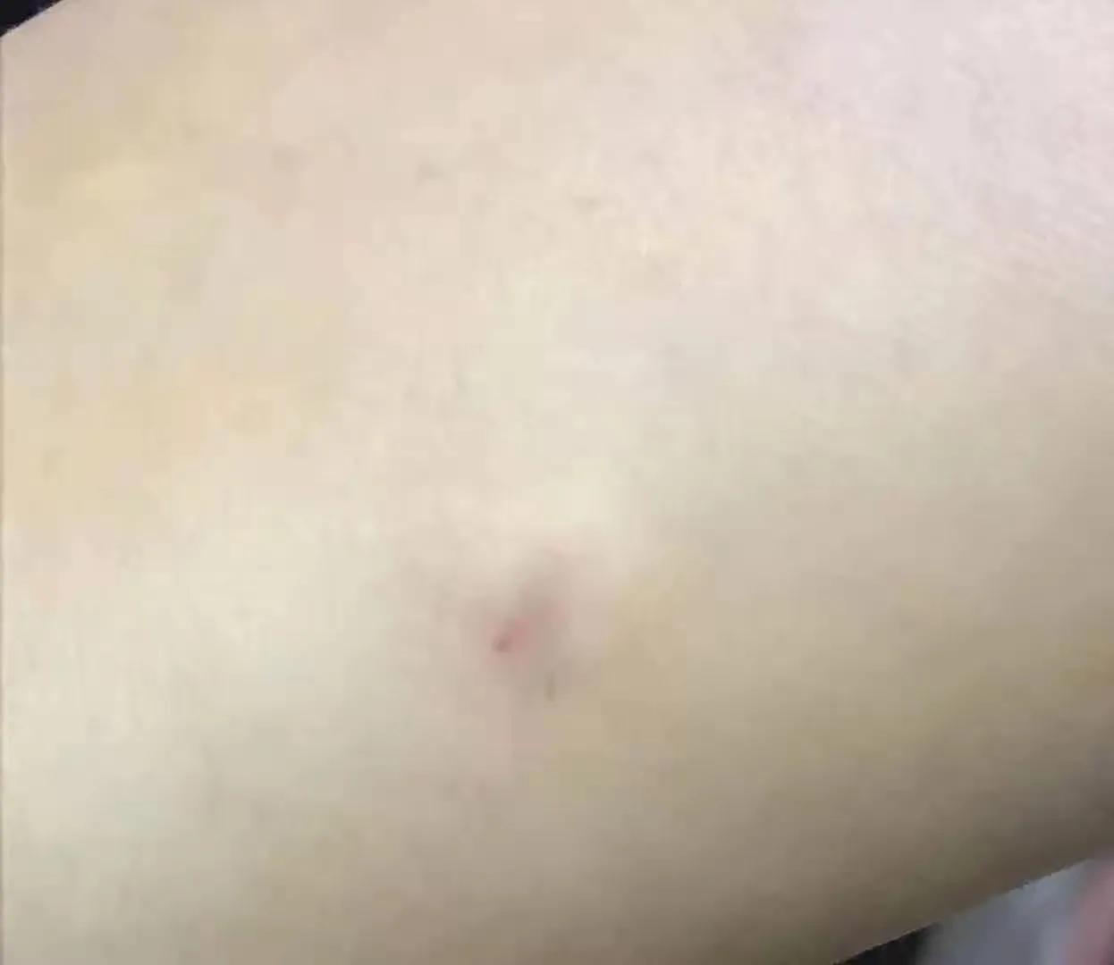 做了皮试但依然过敏死亡,皮试阴性一定是不过敏吗