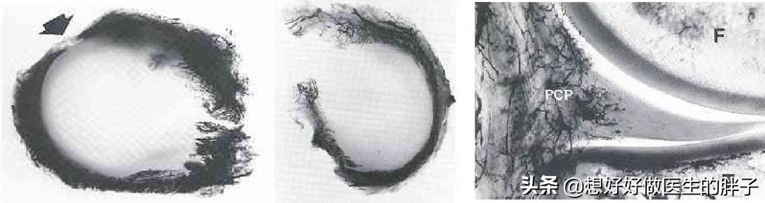 半月板损伤对足球运动员有多严重,足球运动员有半月板问题吗