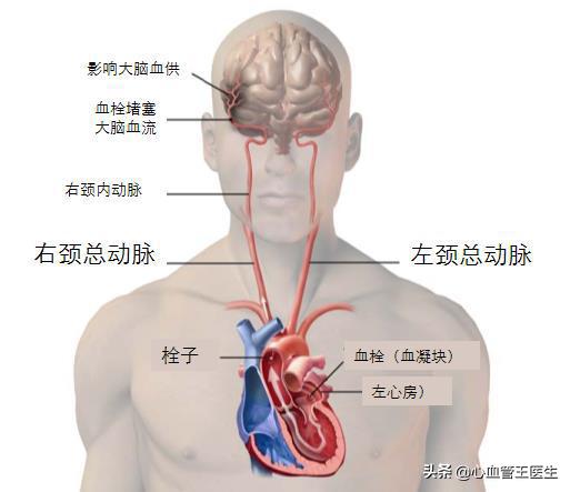 高血压性心脏病科普视频,脑梗死合并房颤如何控制房颤