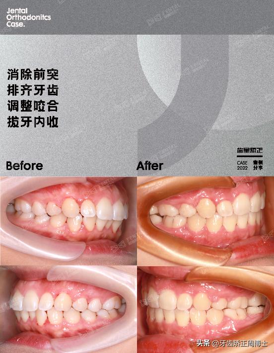 骨性龅牙矫正牙齿变小了,骨性龅牙已经做了正畸手术怎么办