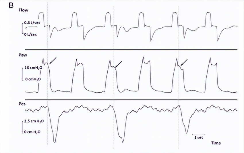 罗红教授,机械通气波形分析和临床应用