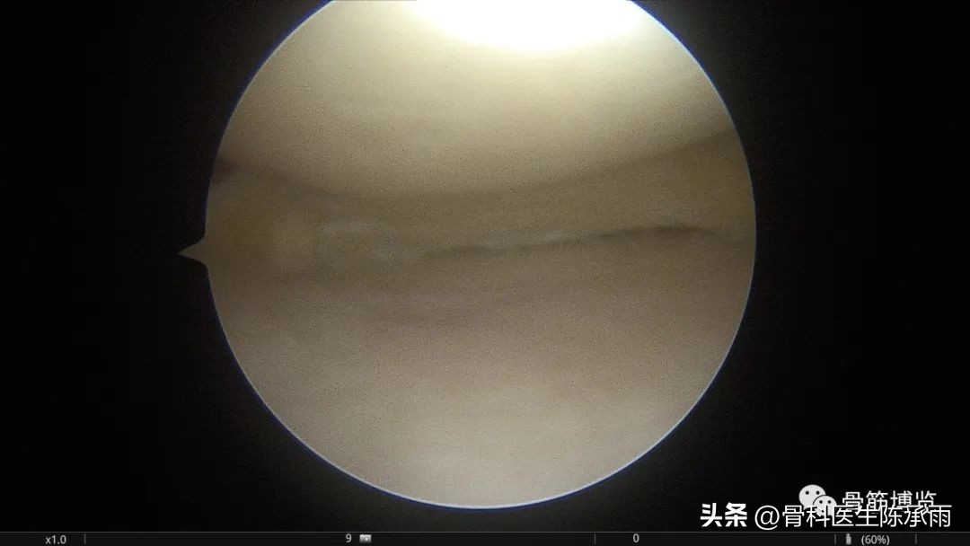 盘状半月板撕裂一级,半月板层裂愈合概率