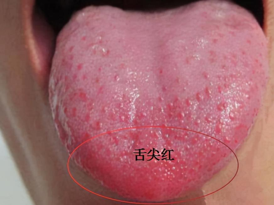 心火烦躁失眠易醒吃什么药,心火旺失眠心悸