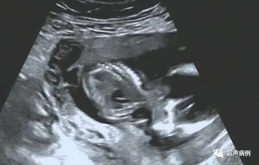 带器妊娠是什么意思,戴节育器妊娠会有什么症状