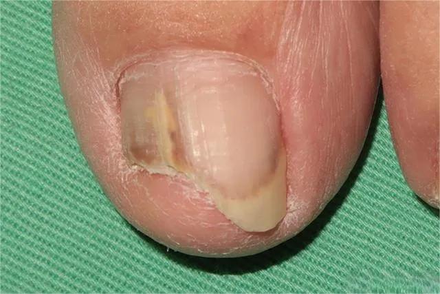 甲癣不严重怎么治疗,甲易生治疗灰指甲吗