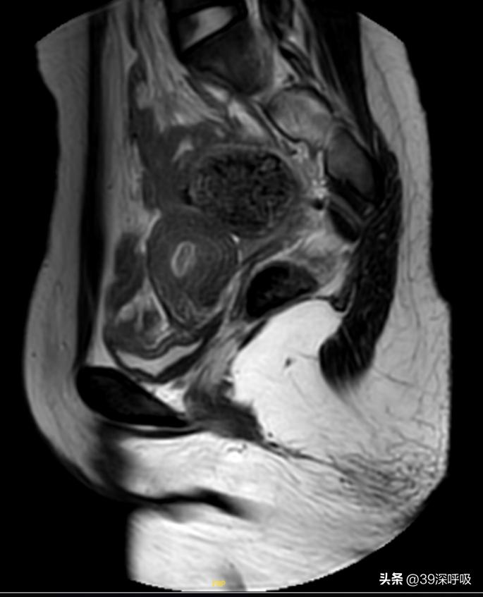 17岁女孩没有来月经,23岁女生从未来过月经能治好吗