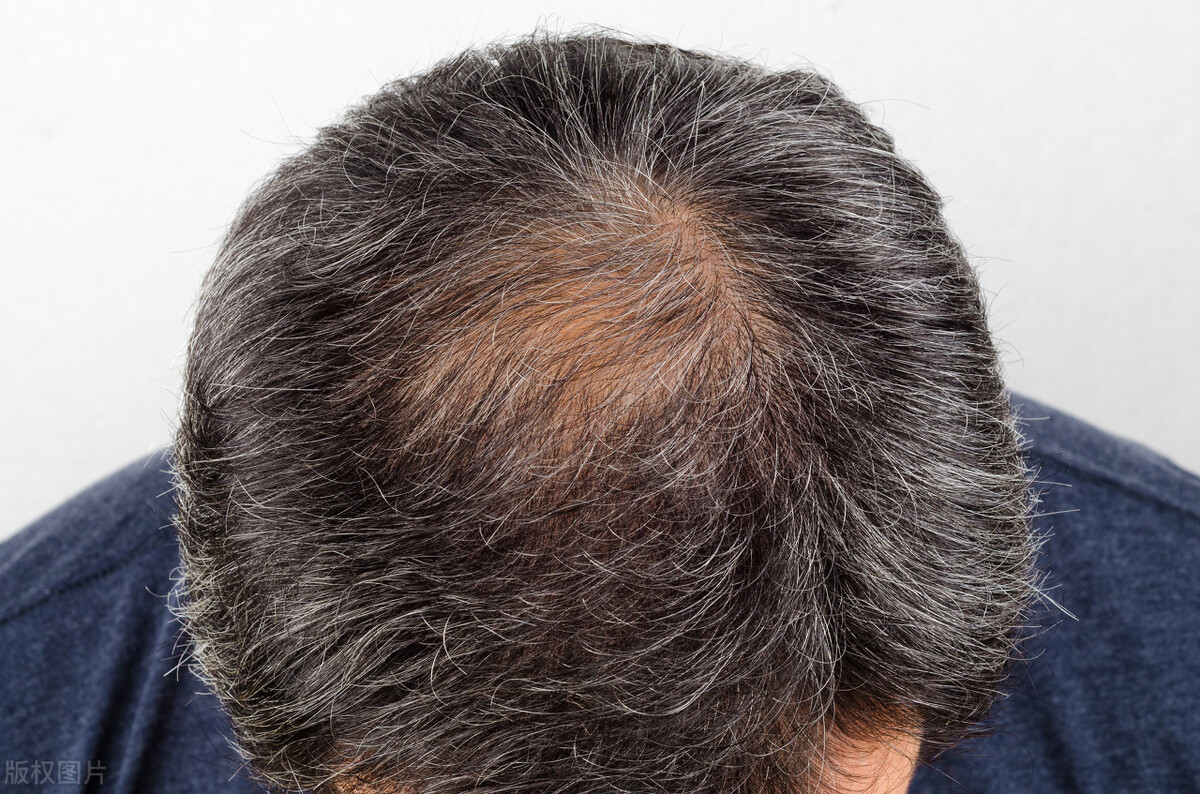 白头发是缺乏什么营养呢,白头发越长越多是缺什么营养