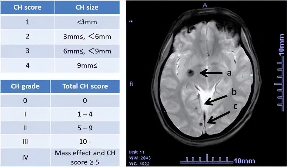 脑海绵状血管瘤引起癫痫怎么治,脑右侧顶叶海绵状血管瘤的危害