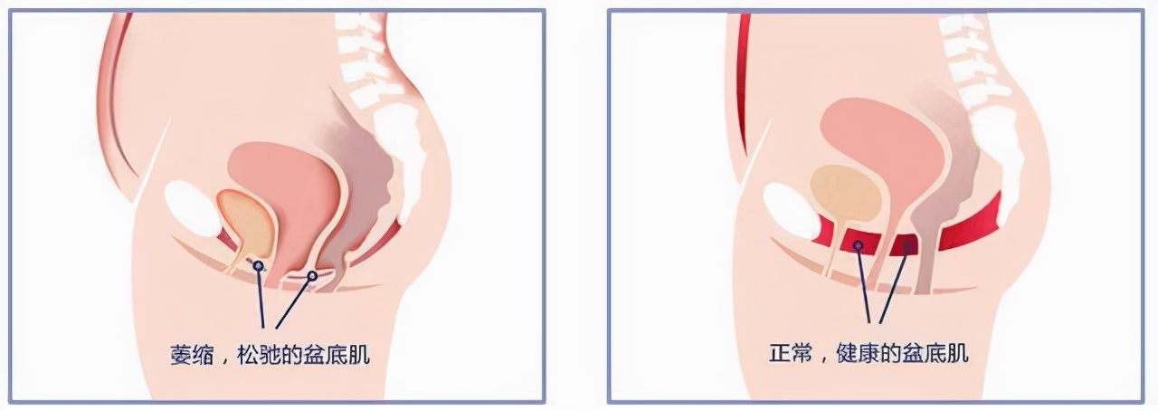 产后、绝经是道坎，盆底知多少？