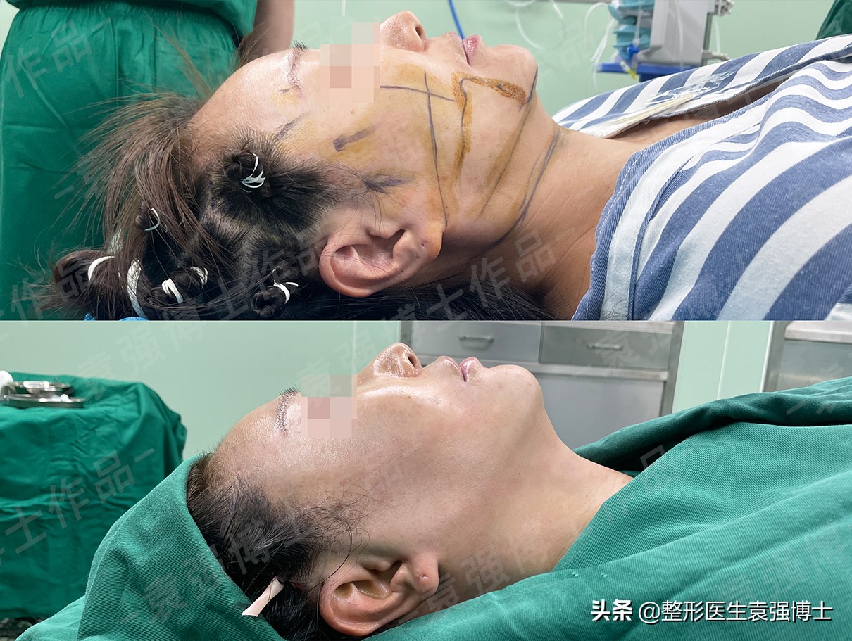 45岁脸垮有什么办法,四十岁怎样防止脸部发腮