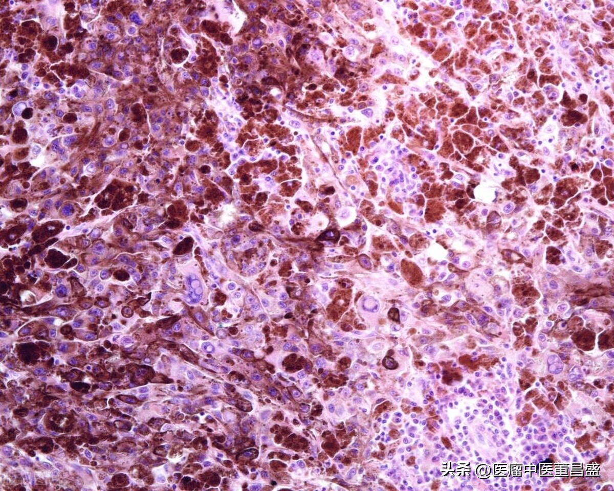 健康科普黑色素瘤到底是什么,曝张恒远离世细节