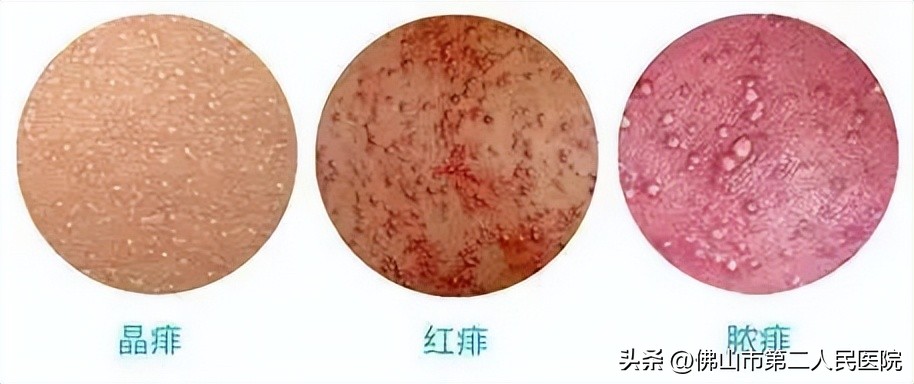 春季易发哪些皮肤病,秋冬常见皮肤病有哪些