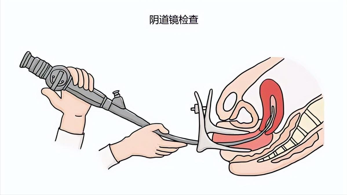 宫颈癌筛查可以查几种hpv,筛查宫颈癌的HPV怎么看是正常