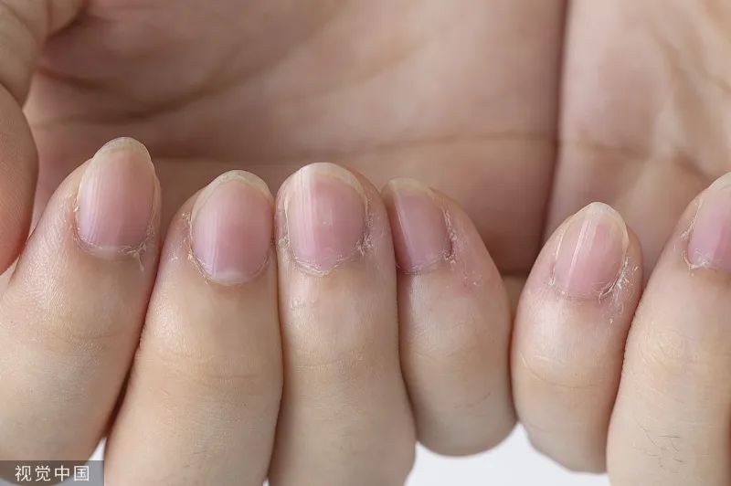 指甲出现凸起横纹当心三大疾病,指甲上有白色斑点和有倒刺