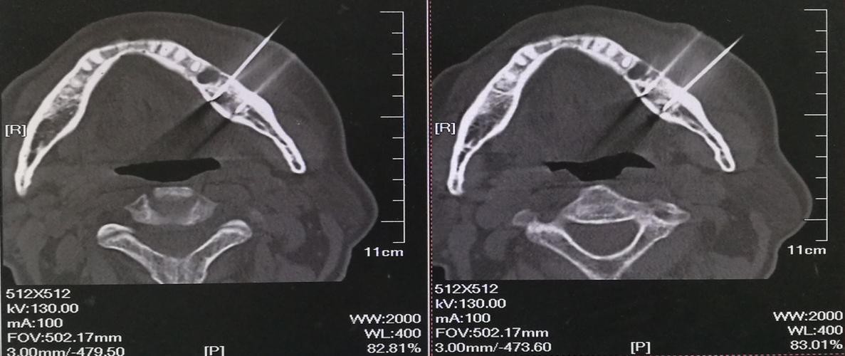 颌骨癌有遗传吗,颌骨癌发病率