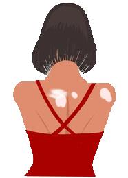 虫斑与花斑癣最主要区别,白癜风和汗斑最快鉴别方法