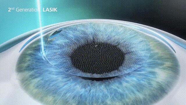 徐州飞秒激光近视手术大概多少钱,激光矫正近视手术全过程全飞秒