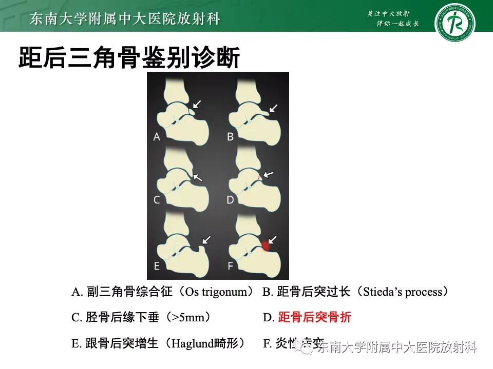 好文分享-《肌骨系统疾病——副舟骨综合征》