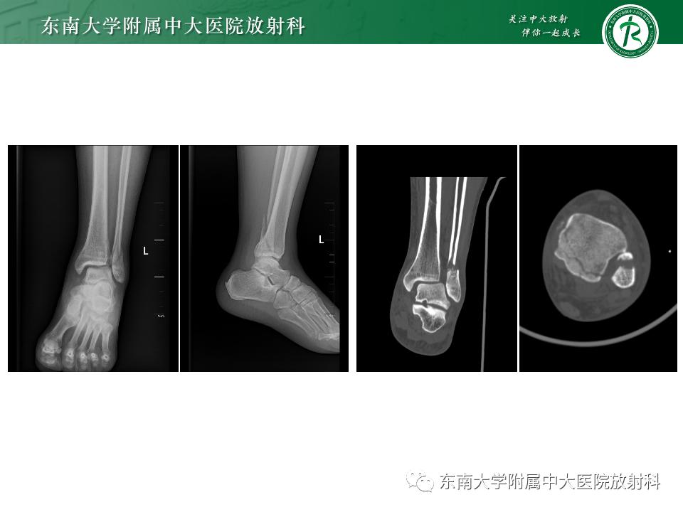 左腓骨下段骨折伴下胫腓联合分离,好文分享深度揭秘