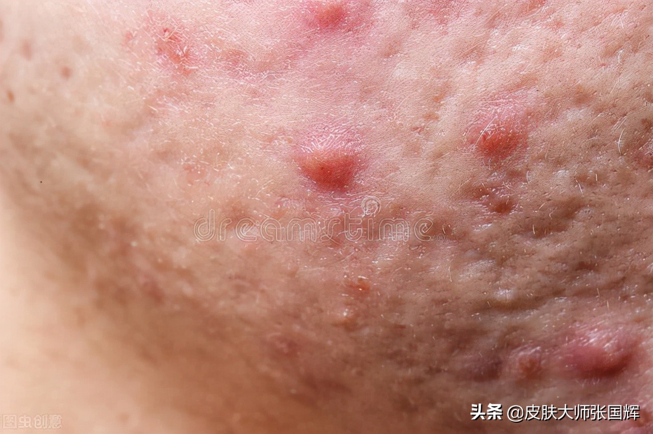 各种痘痘类型及治疗方法,各种痘痘类型治疗方法