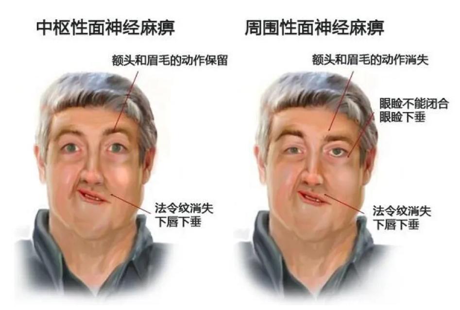 耀县看面瘫的在哪里,夏天得了面瘫