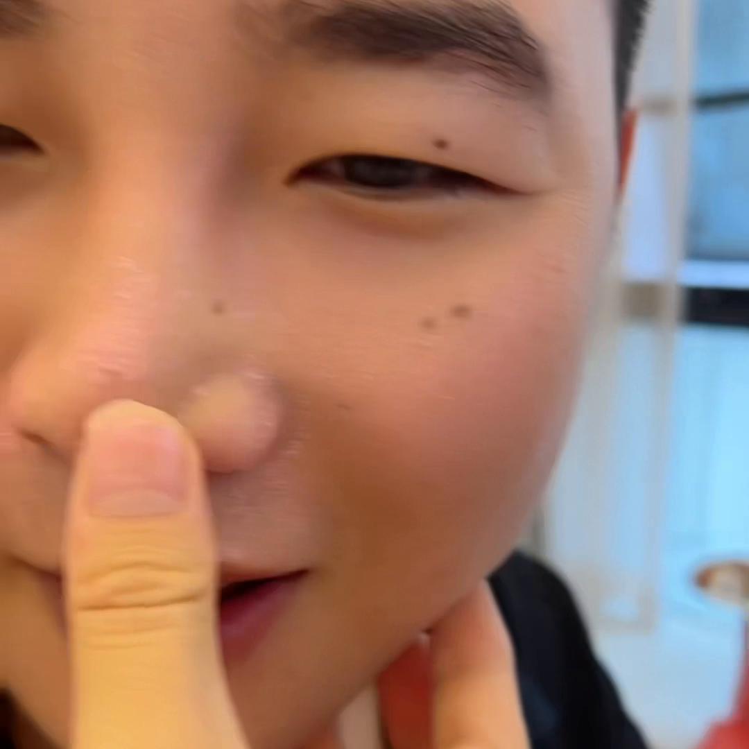 有必要经常去黑头么,有没有必要去黑头