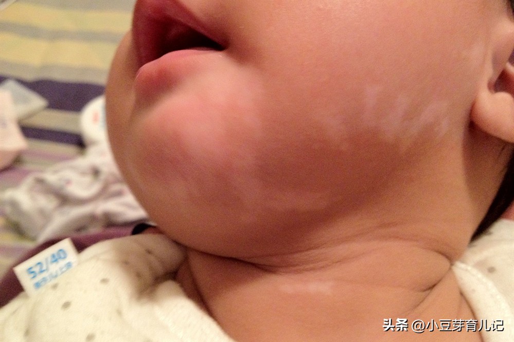 宝宝大腿后突然淤青一块,宝宝大腿有淤青怎么回事