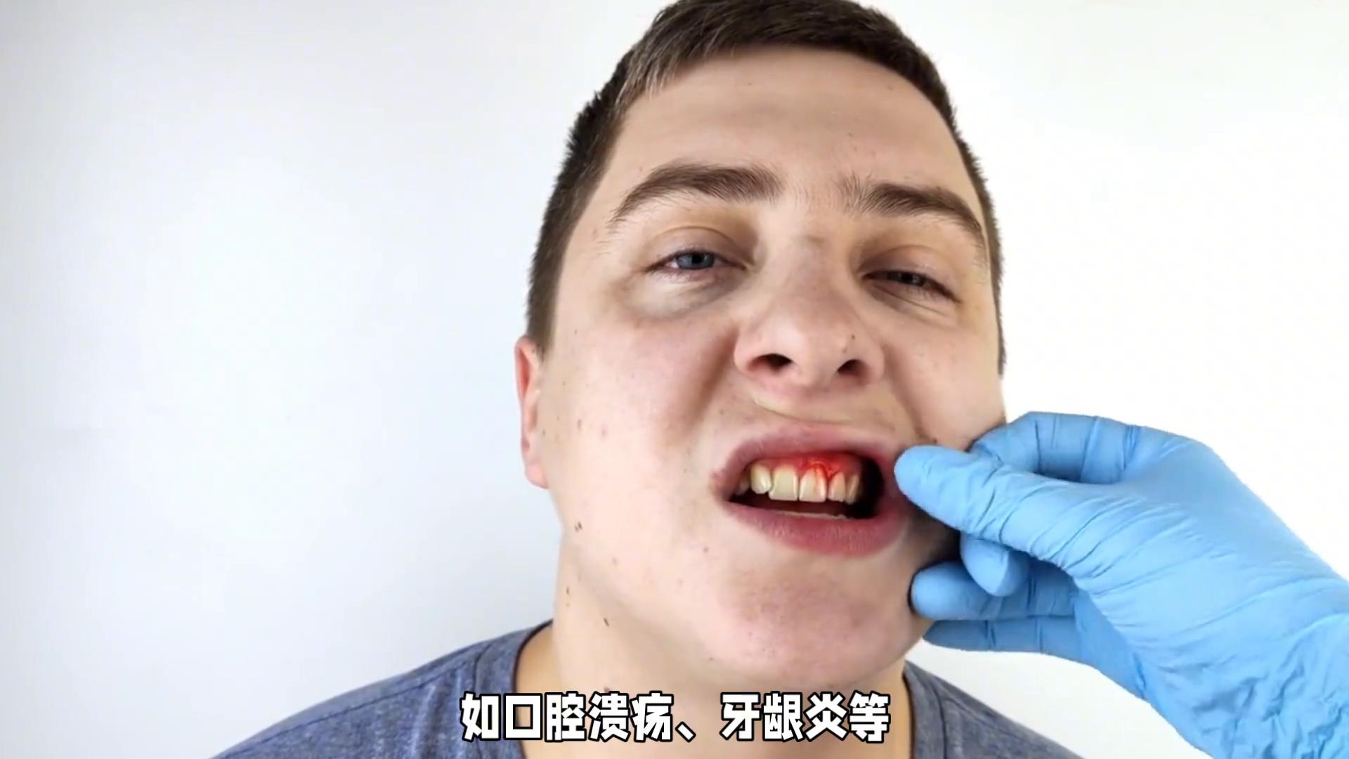 口面指综合征遗传方式,口面指综合征1型