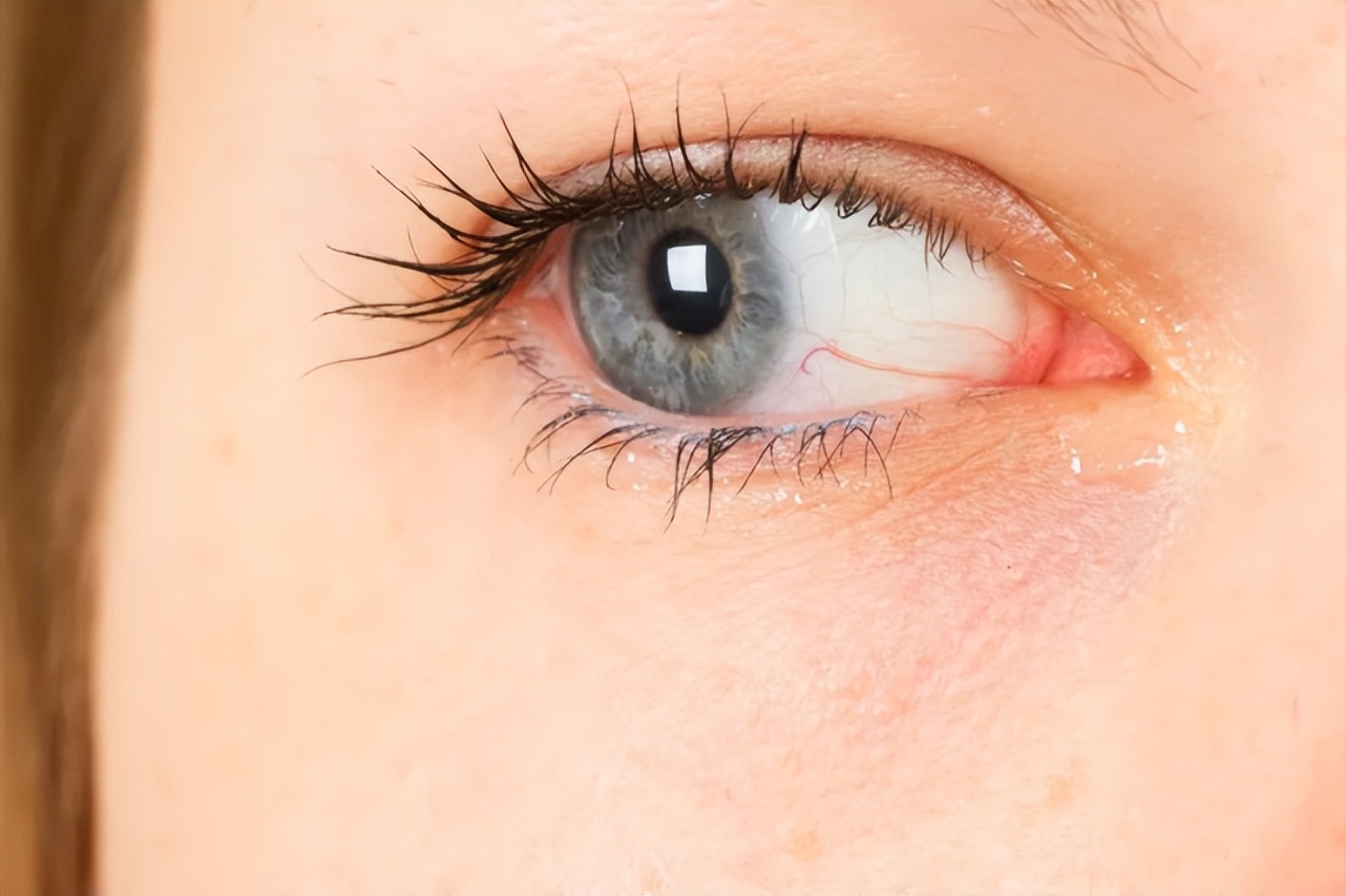 白眼球有血丝发黄是什么原因,白眼球发黄浑浊好几年了什么原因