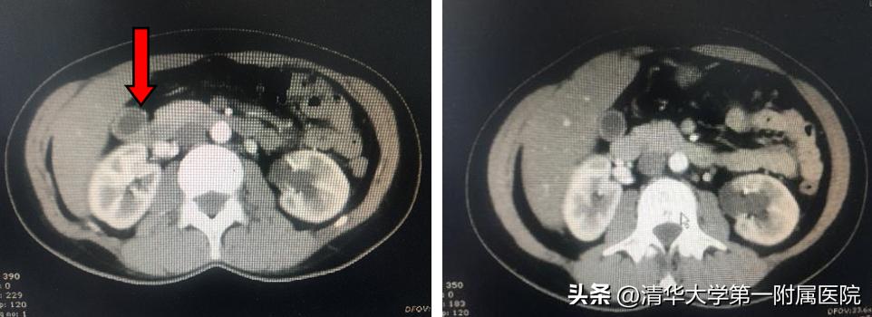 胆囊什么情况需要住院治疗,胆囊有病什么药最好