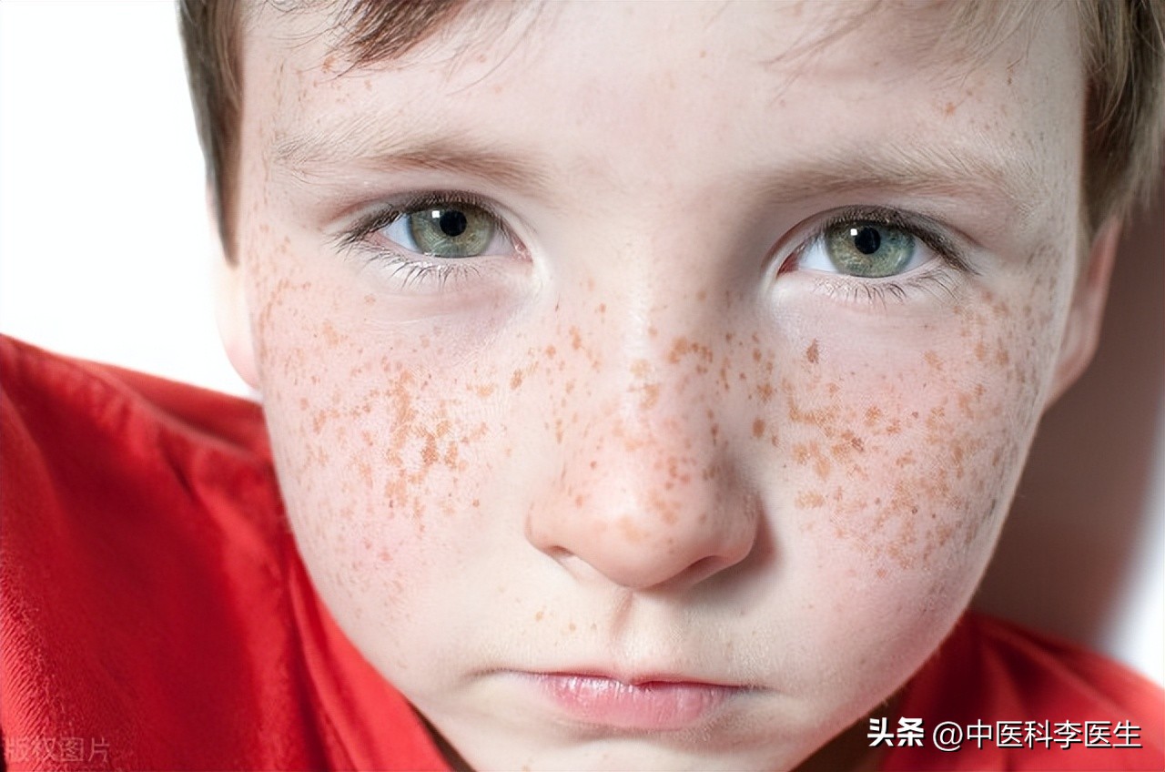 雀斑黄褐斑老年斑晒斑怎么区分,褐斑老年斑怎么治疗效果最好