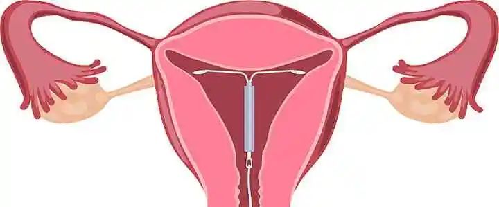 人工流产避孕注意什么,人工流产避孕