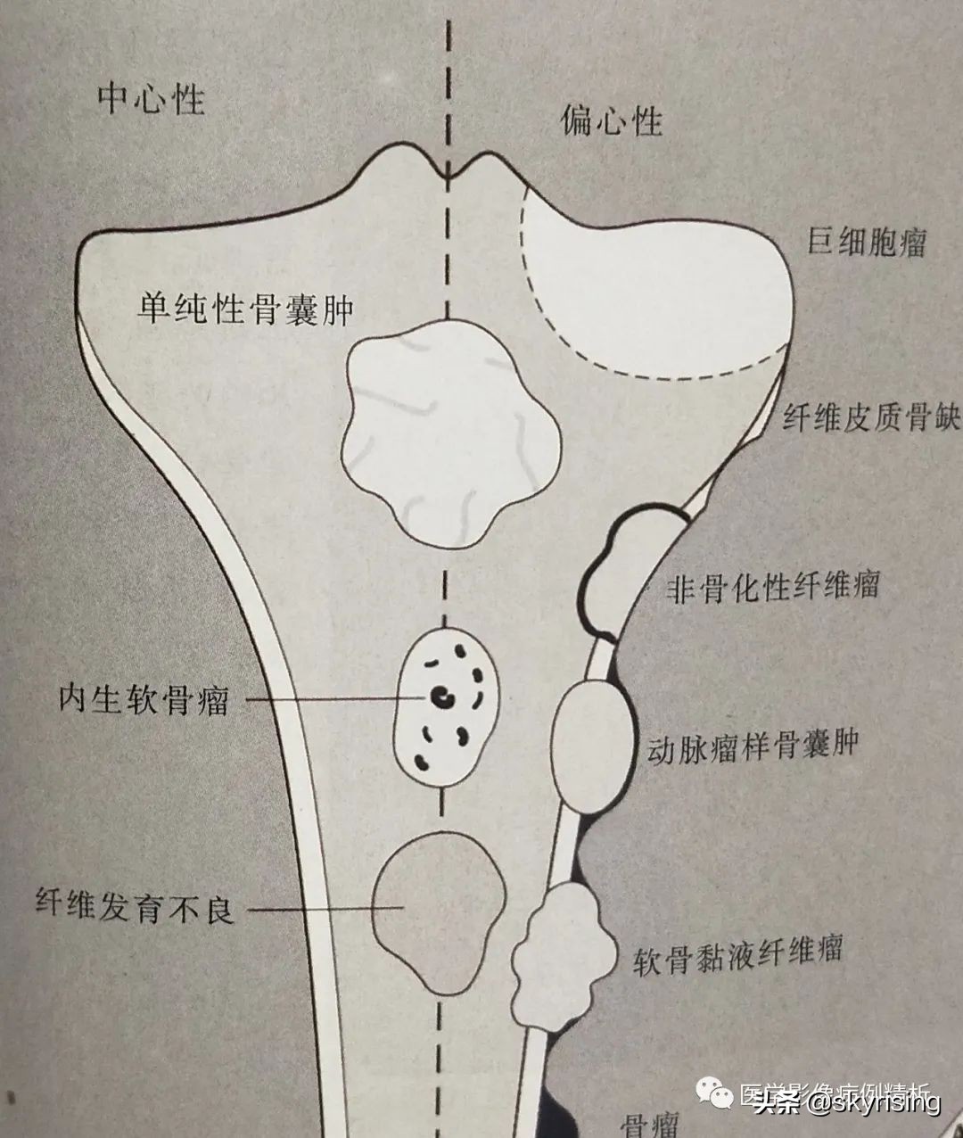 脊索瘤造成骨质破坏严重吗,多发椎体骨质破坏考虑转移瘤