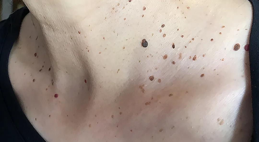 皮肤科董医生:“卤蛋哥”后腰长的真是湿疣?